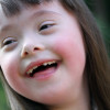 Una bambina affetta da sindrome di Down