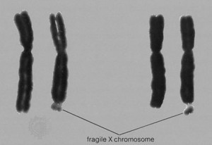 L'alterazione cromosomica che contraddistingue la sindrome X Fragile